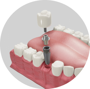 implant